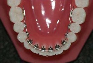 lingual braces orthodontic treatment in Pune 